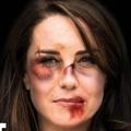 Kate Middleton défigurée par des hématomes, l’image choc d’une campagne contre les violences conjugales
